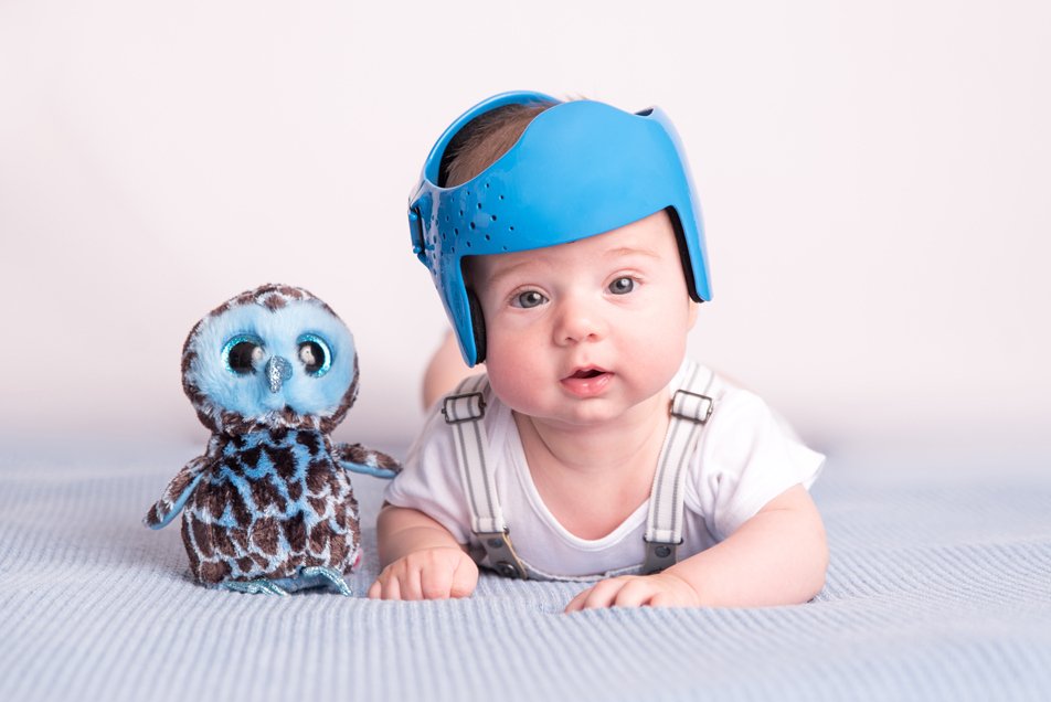 Casque 3D pour plagiocéphalie, de la mesure à la livraison